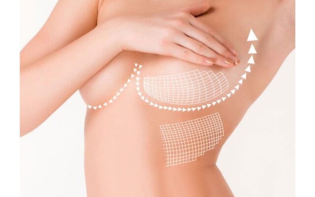 Nâng ngực có bị ung thư không