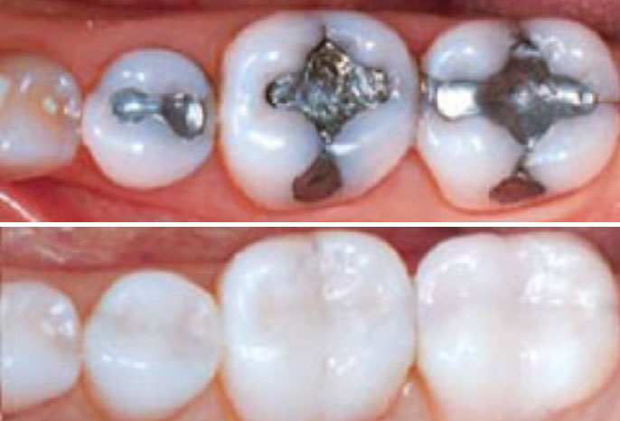 trám răng thẩm mỹ đẹp