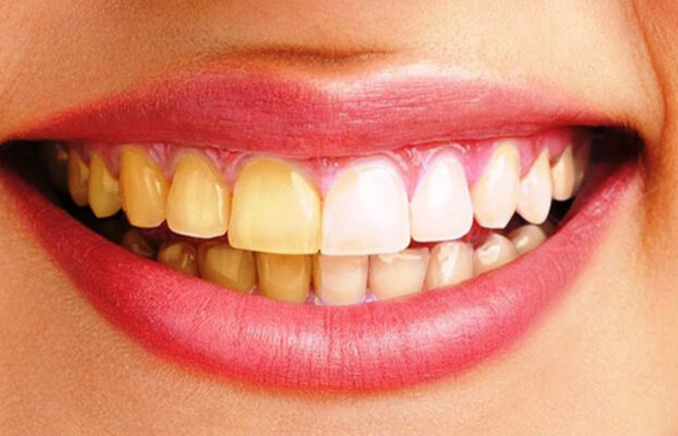 cach lam trang rang bi vang