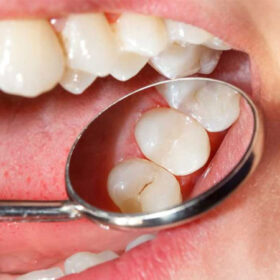 tram rang sau bao nhieu tien