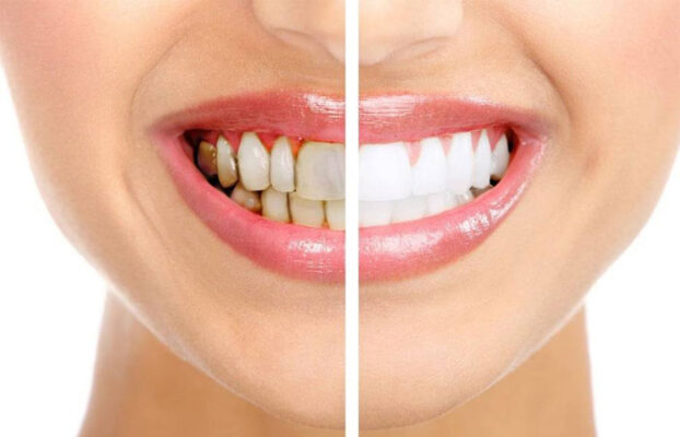 cao voi rang co trang rang khong