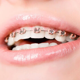 nieng rang ho nhe bao nhieu tien