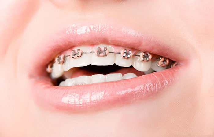 nieng rang ho nhe bao nhieu tien